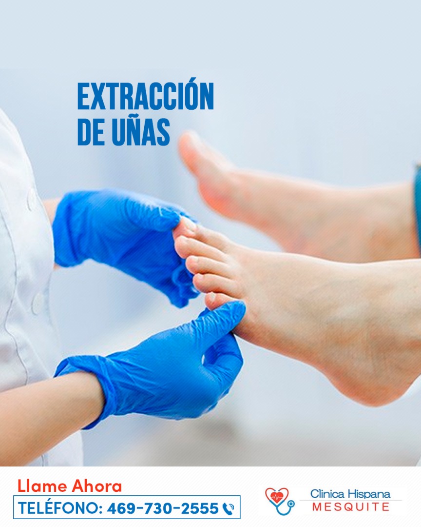 Extracción de uñas