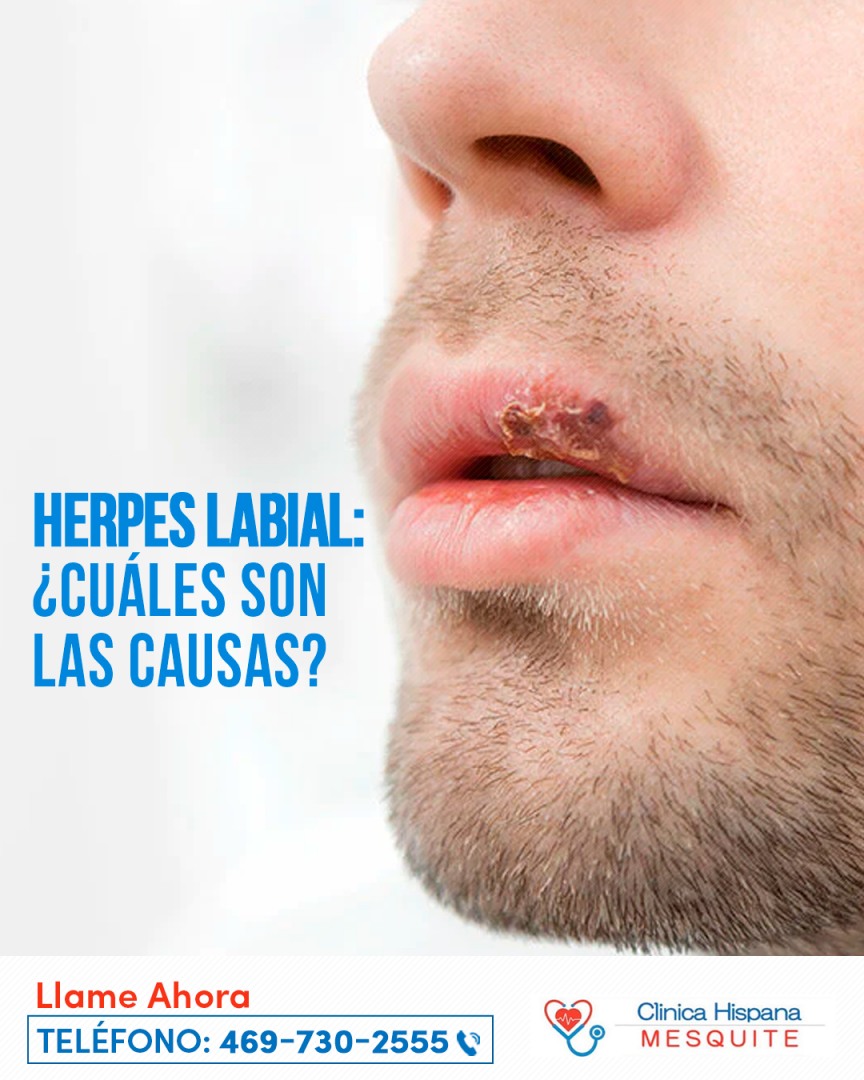 Herpes labial